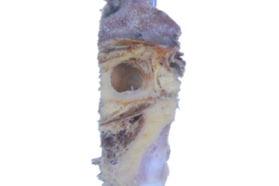 鼻咽鳞状细胞癌（背部）